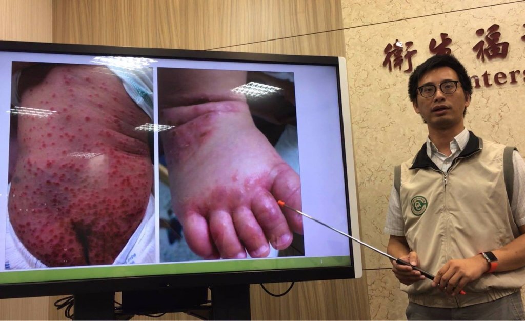 Taipei accueillera un forum international sur le diagnostic de l’entérovirus