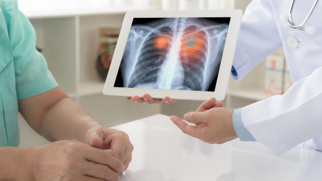 Une technique innovante  grâce à l'IA pour personnaliser le diagnostic et le traitement du cancer du poumon